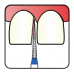 Osung Crown Anterior/ Proximal Cutting, Lingual Reduction Straight FG Shank 164-10M2 (165 858 010) Medium Grit Diamond Bur 5/PK